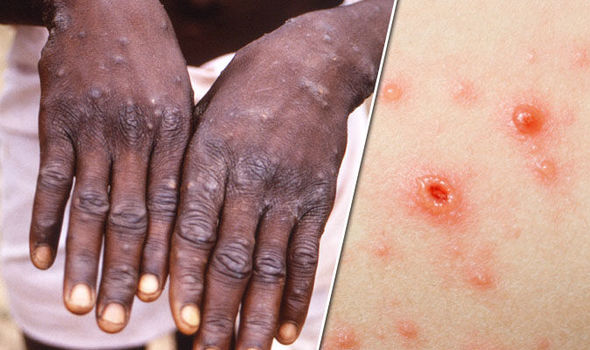 Umubiri uracyahatwa inshinge: America igiye gukingira MonkeyPox nyuma ya COVID-19