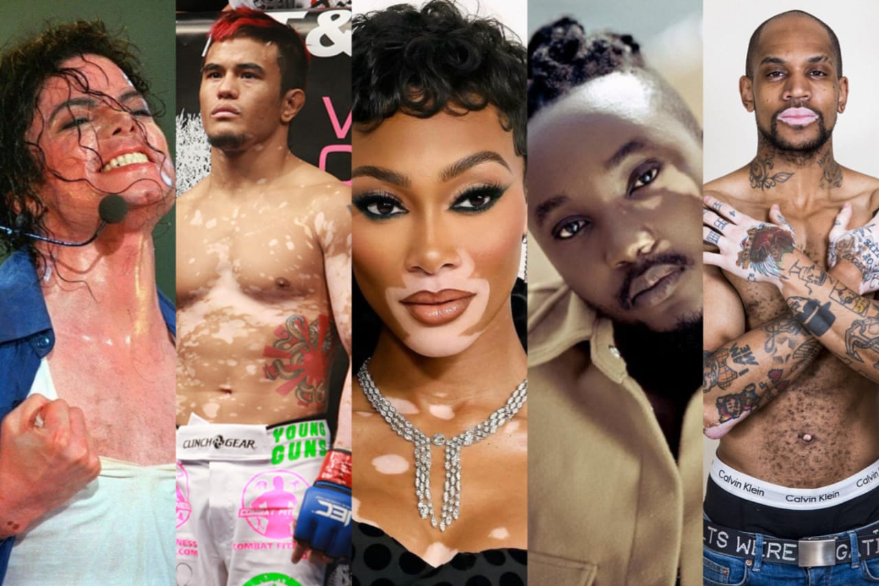 Harimo Umunyarwanda! Ibyamamare 20 byibasiwe n’indwara y’Ibibara “Vitiligo " - AMAFOTO